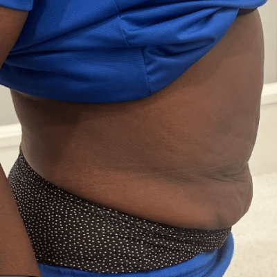 CRYO-SLIMMING